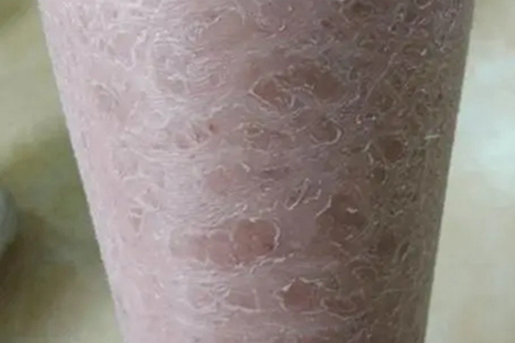 皲裂性湿疹小腿症状图