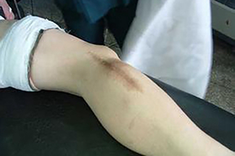 滑膜肉瘤小腿肿起来图