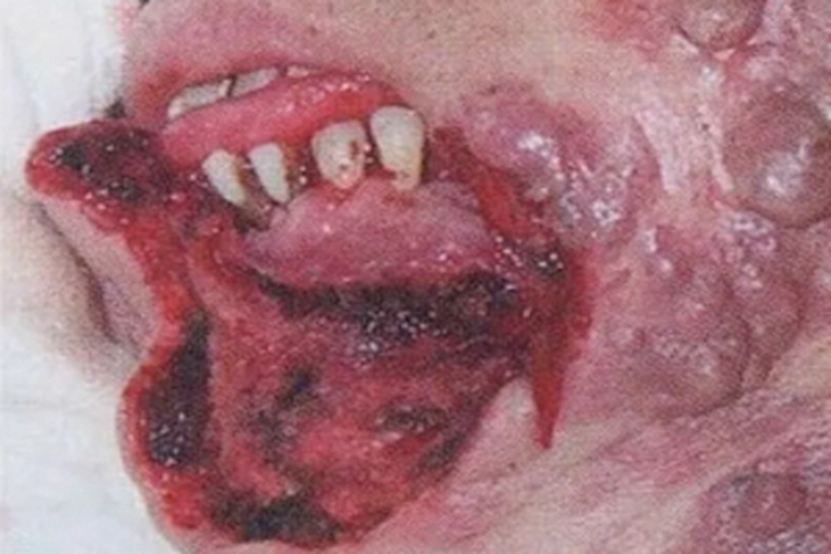 唇缺损下嘴唇没了图 唇缺损下嘴唇没了图