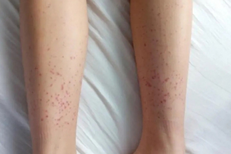 特发性血小板减少性紫癜红点图 特发性血小板减少性紫癜红点图