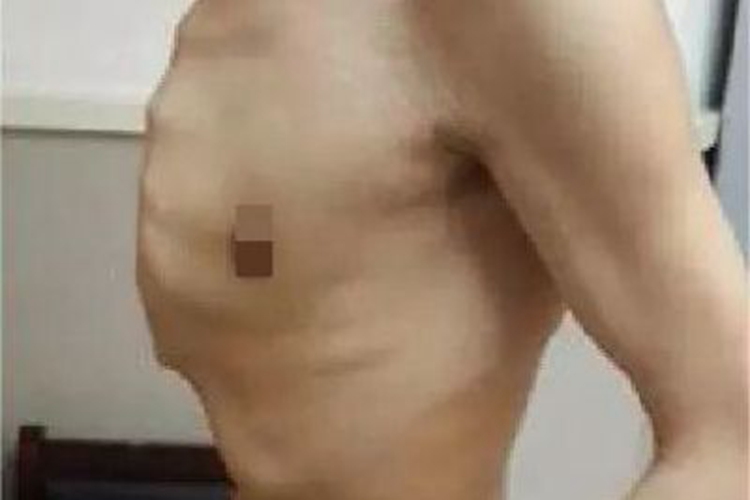 鸡胸胸骨特别突出图 鸡胸胸骨特别突出图