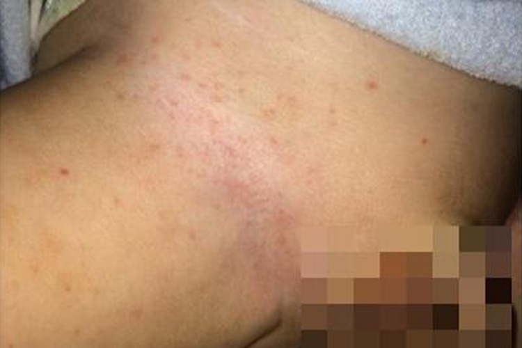 渗出型婴儿湿疹大腿丘疹图 渗出型婴儿湿疹大腿丘疹图