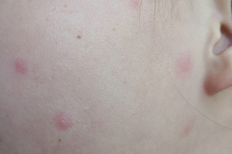 水痘脸上长几个红点图