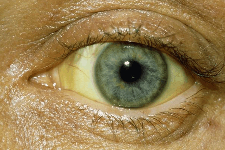 肝癌早期黄疸图