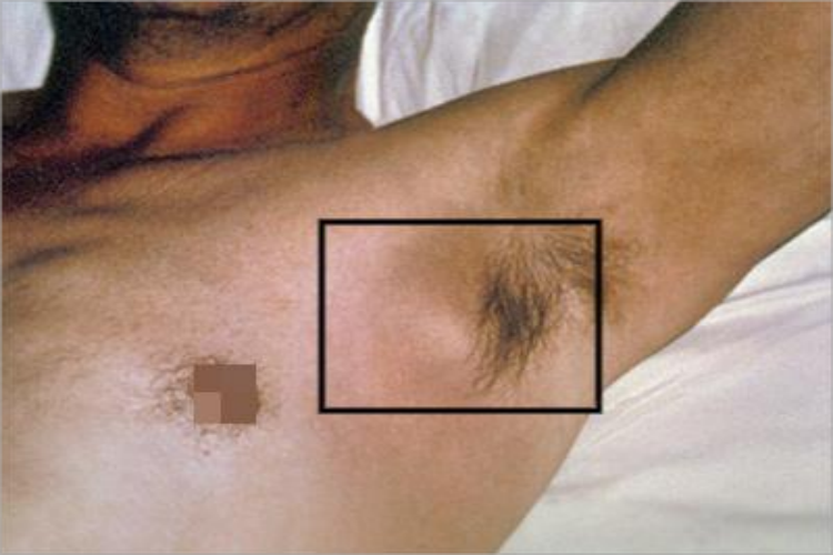 乳头状汗腺腺瘤大包图