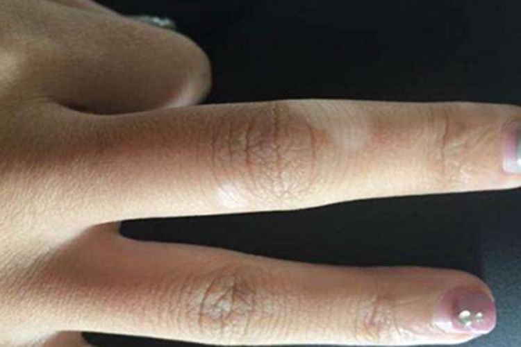 白癜风手指症状图