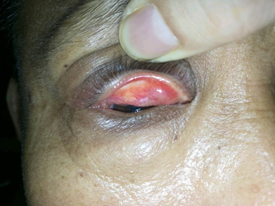 眼睑皮脂腺癌上眼皮内面有黄色结节图.jpg