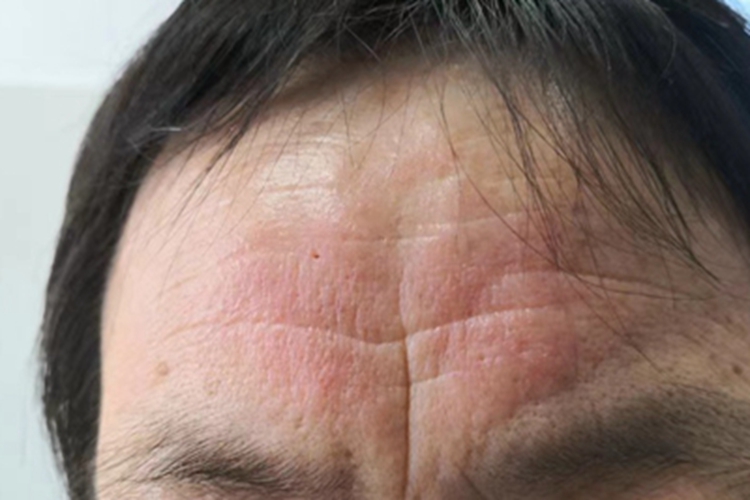 光接触性皮炎前额症状图