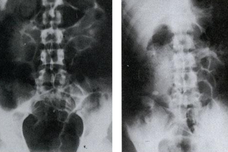 阑尾炎腹部平片图