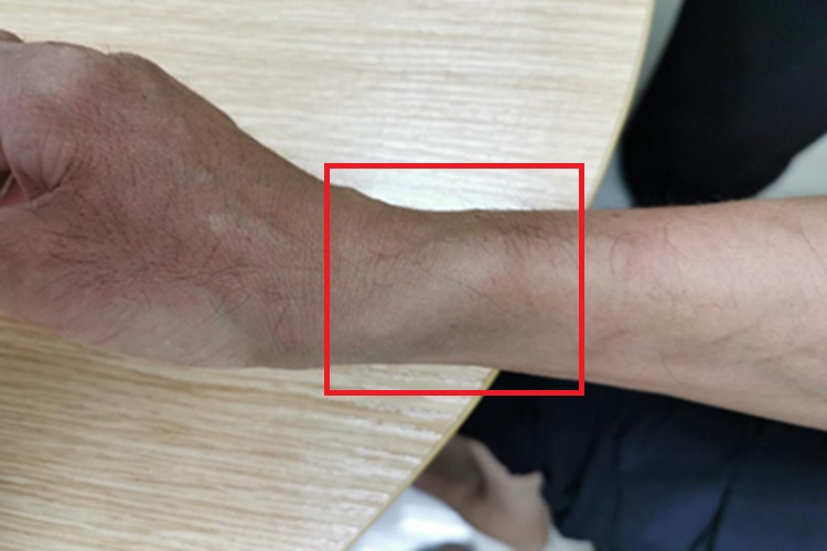 痛风性关节炎胳膊症状图