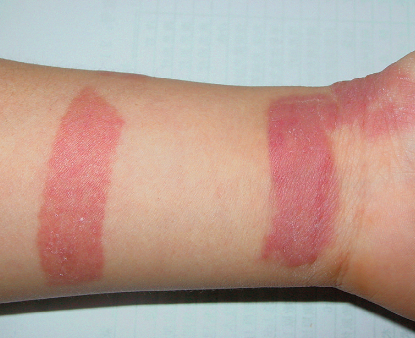 接触性皮炎图