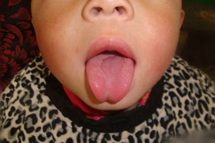 地图舌舌头中间有一块红斑图 地图舌舌头中间有一块红斑图