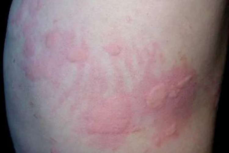 旋毛虫病腰部风团图