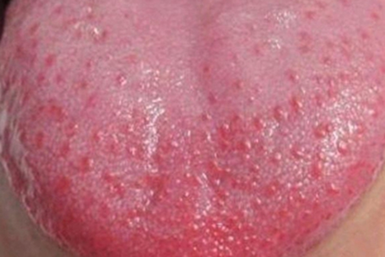 川崎病舌头长小红疙瘩图