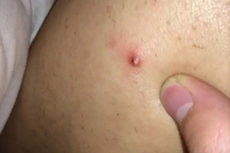 嗜酸性脓疱性毛囊炎小腿丘疹图