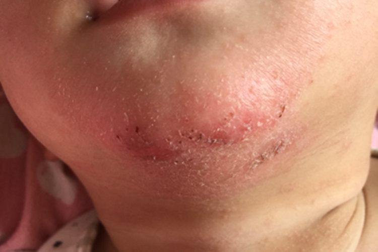 湿疹下巴糜烂图 湿疹下巴糜烂图
