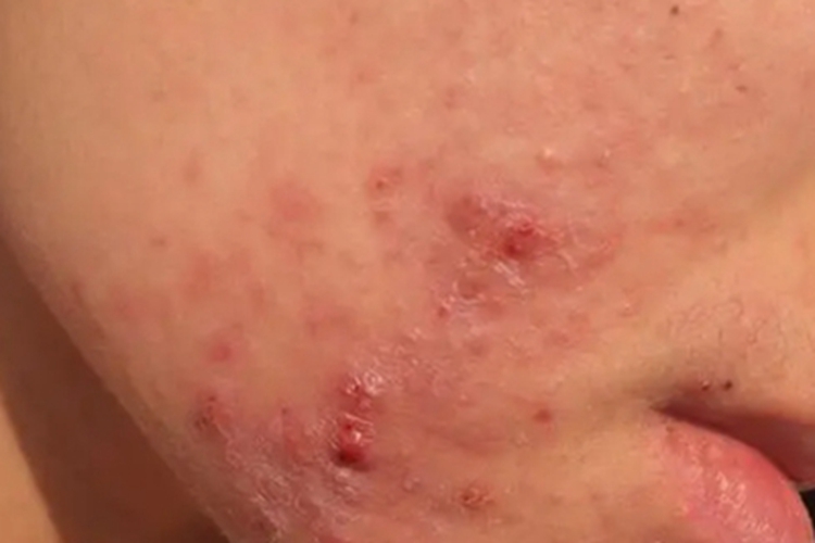 颜面疖痈面部症状图 颜面疖痈面部症状图