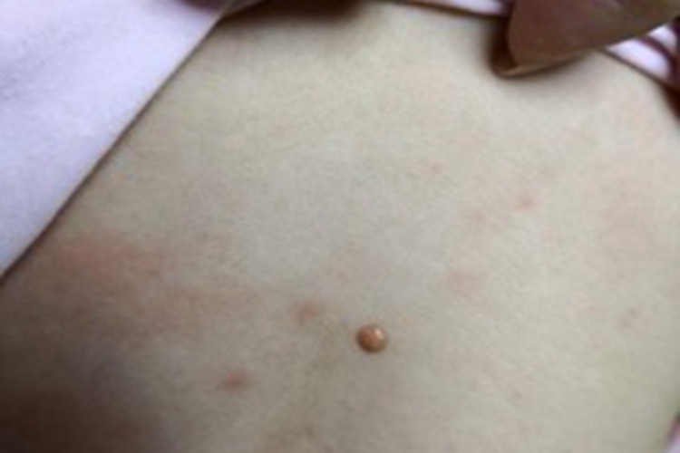 幼年黄色肉芽肿背部疙瘩图