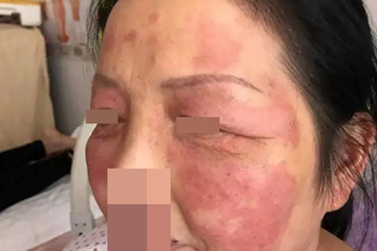 类癌综合征脸上长斑块图 类癌综合征脸上长斑块图