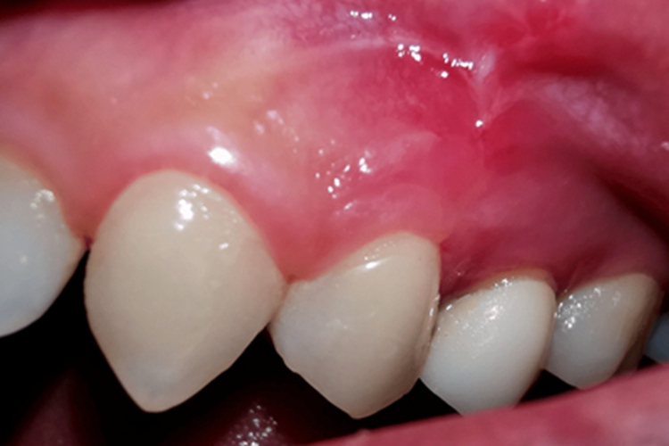 慢性根尖周炎牙龈红肿图 慢性根尖周炎牙龈红肿图