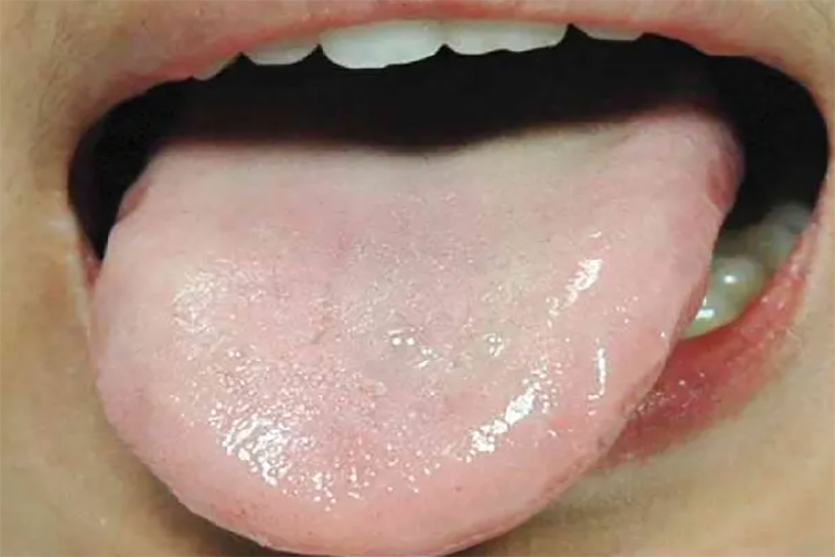 脾胃虚寒舌头图