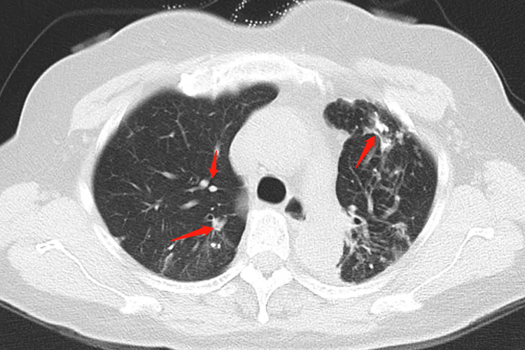 肺结核干酪样坏死影像图