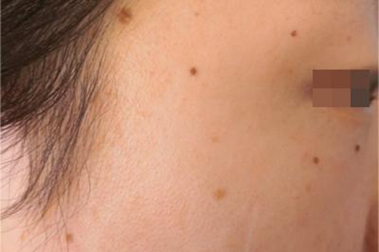 交界痣脸上有很多痣图