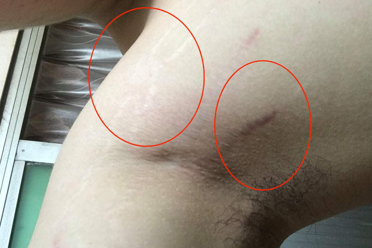 腋窝下萎缩纹图
