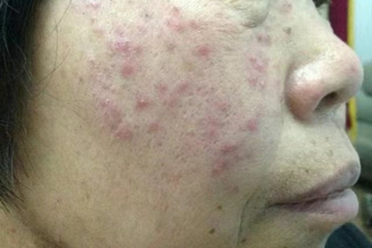 丘疹脓疱型玫瑰痤疮丘疹
