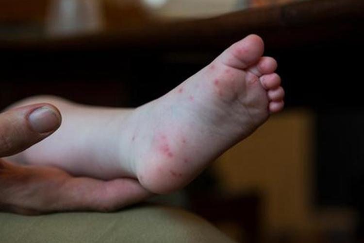 手足口病脚底红色斑疹图
