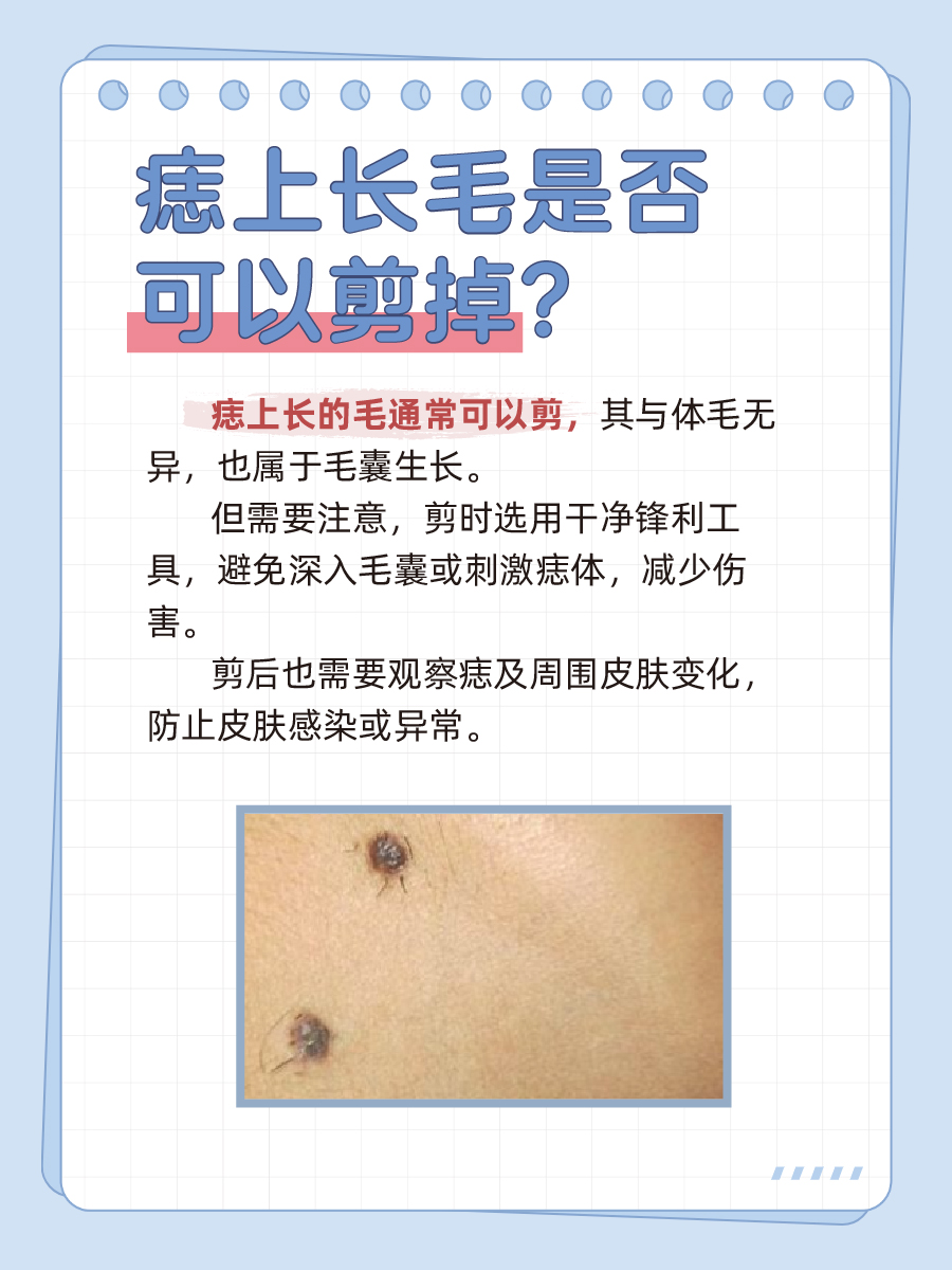 痣上长毛可以剪掉吗?一文解析