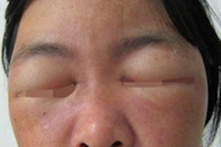 植物光皮炎眼睑浮肿图