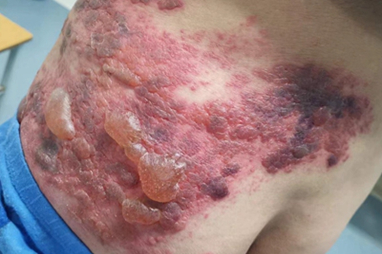 带状疱疹疙瘩图