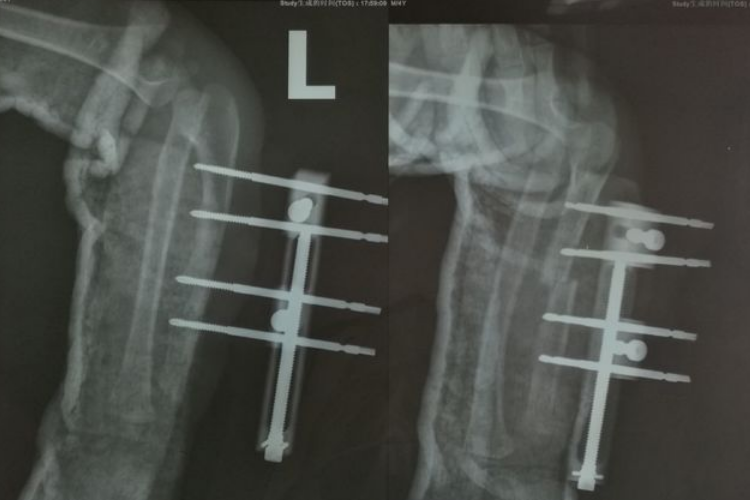 骨延长开始外固定图