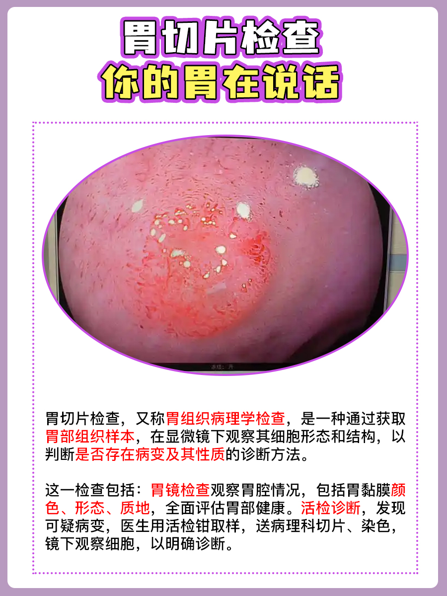 胃切片检查，轻松解读胃状况