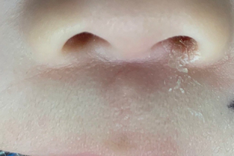 皮样囊肿肿块图