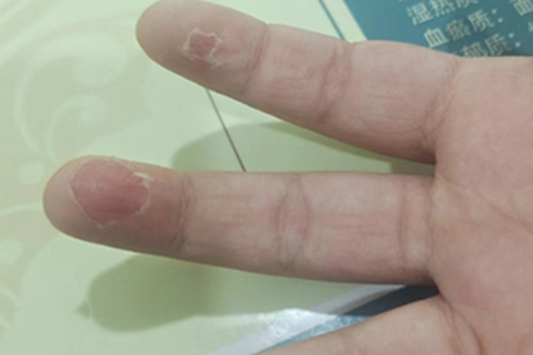剥脱性角质松解症手指症状图 剥脱性角质松解症手指症状图