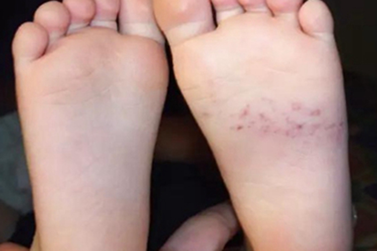 蚋叮咬引起的皮肤反应脚底红点图 蚋叮咬引起的皮肤反应脚底红点图