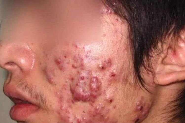 脸上痤疮图 脸上痤疮图