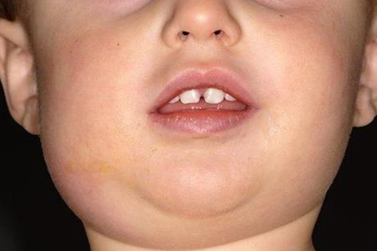 腮腺炎脸颊肿胀图 腮腺炎脸颊肿胀图