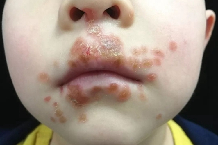 口周皮炎口周丘疱疹图