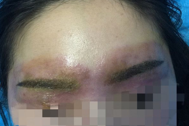 纹眉排异反应图