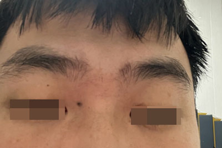 交界痣眼周有黑痣图