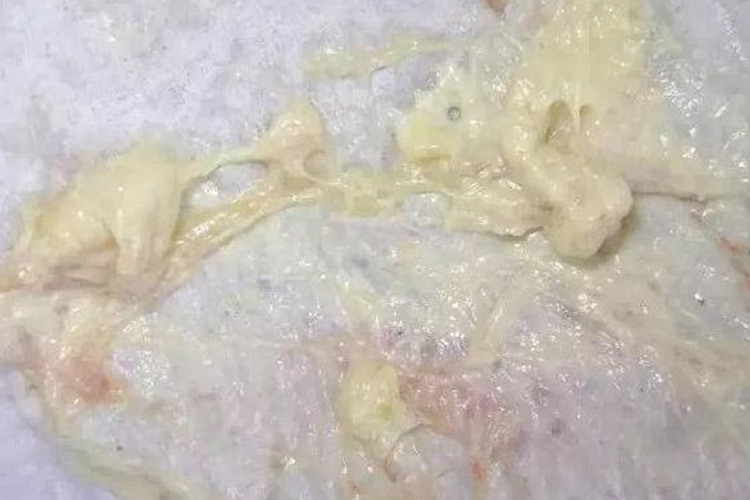 病理性黄疸白色大便图