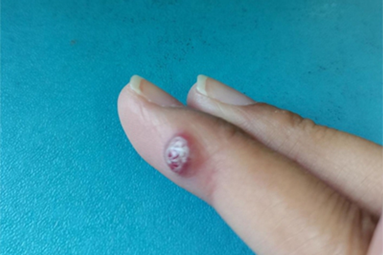 肉芽肿型血管瘤手指疙瘩图 肉芽肿型血管瘤手指疙瘩图