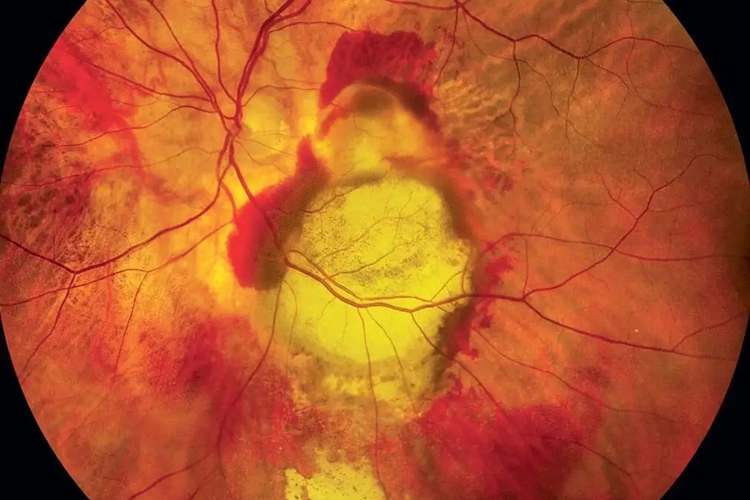 视网膜出血图
