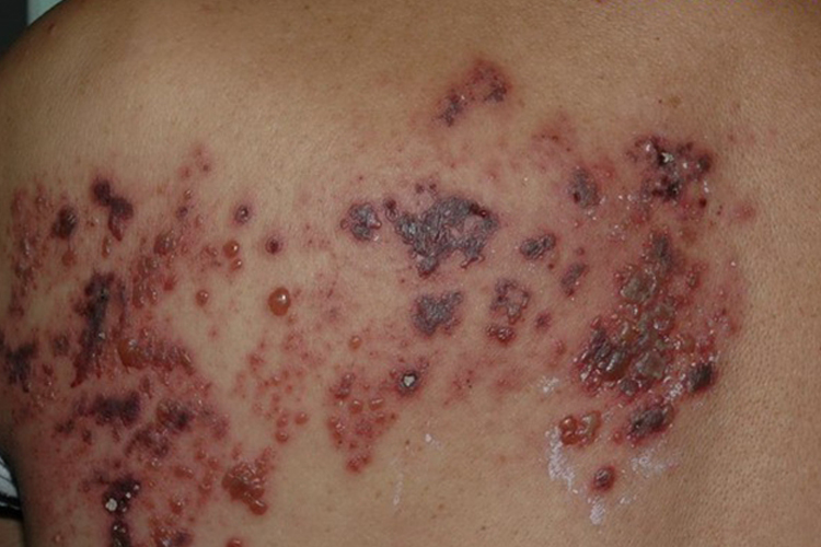 后背带状疱疹图