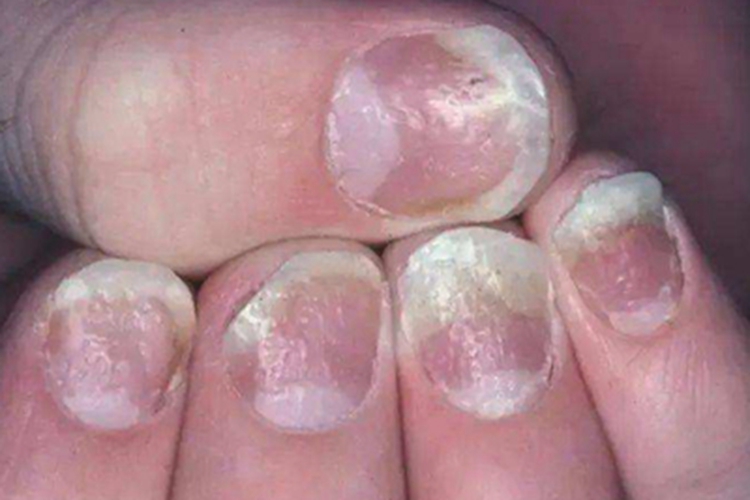 脱甲病手指甲坑坑洼洼图