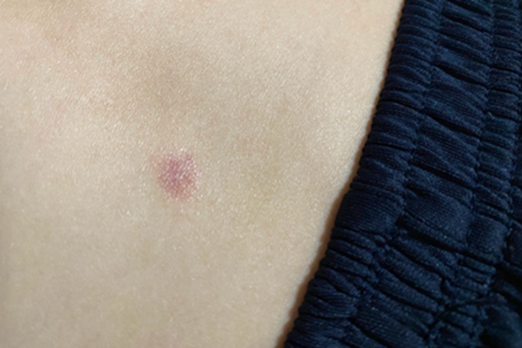 体癣腹部红斑图 体癣腹部红斑图