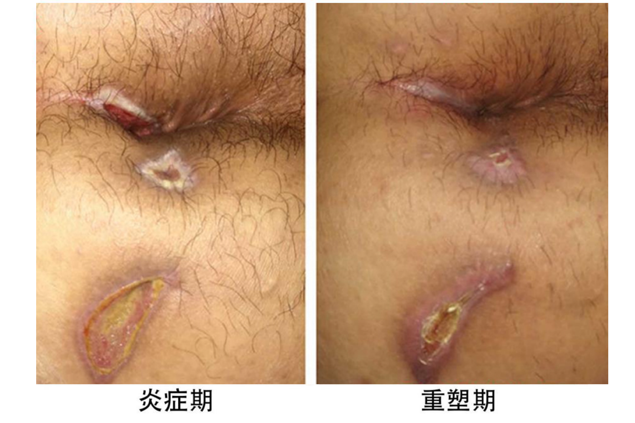 肛瘘手术伤口愈合炎症期/重塑期图